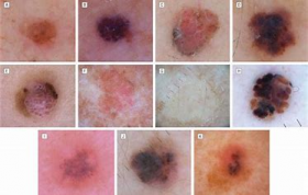 Come Riconoscere un melanoma - Prof. Francesco Di Costanzo, 